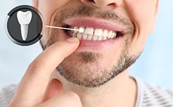 A man showing his implanted teeth on a light background